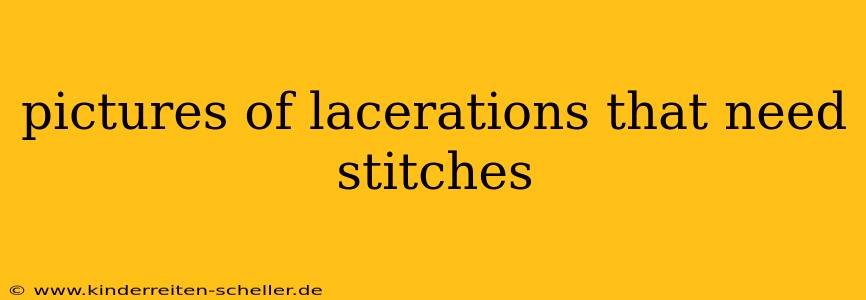pictures of lacerations that need stitches