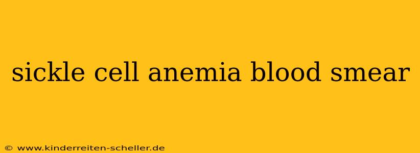 sickle cell anemia blood smear