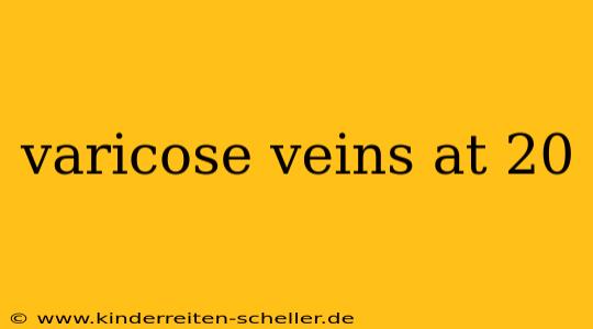 varicose veins at 20